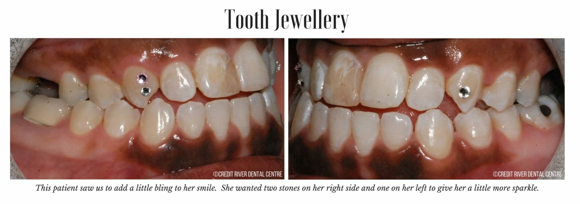 Dental tooth gems, sparkles and gold tooth jewelry? So much choice we have!