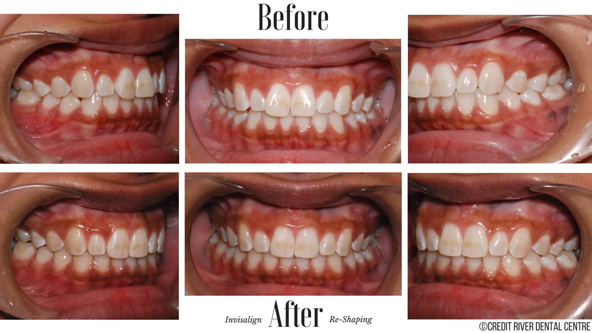 Invisalign Mississauga, ON  Invisible Braces / Clear Aligners